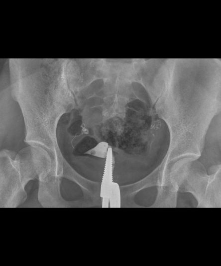 15_HSG -Histerosalphingography ap