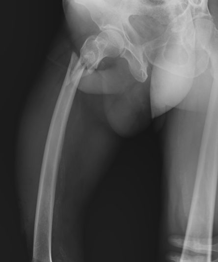 25 Femur Hip Joint Lateral