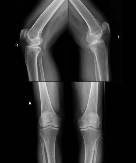34 Knee