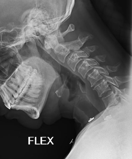39 C Spine Flex