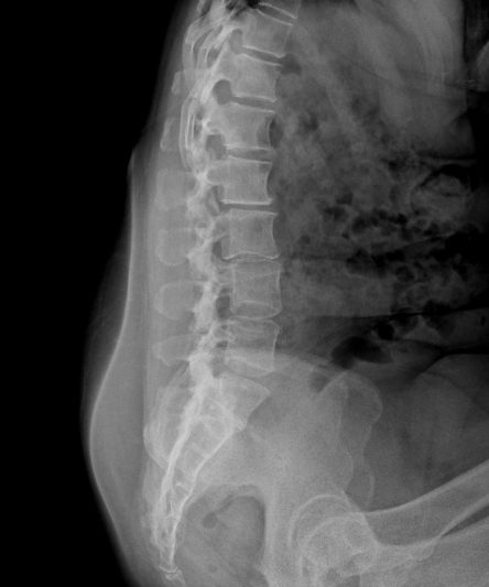 44 Lumbar LAT Sitting (90 kg)