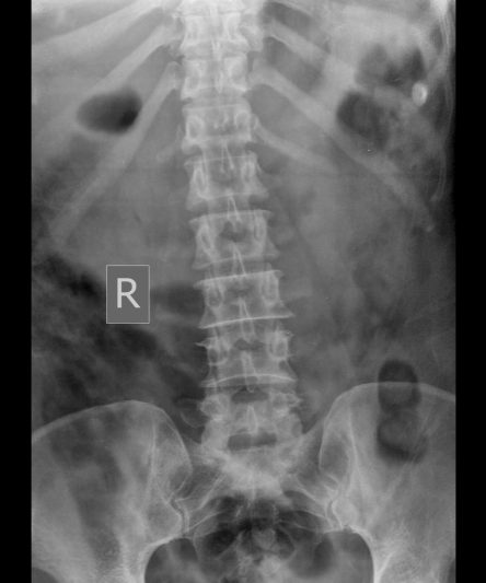 48 -Lumbar
