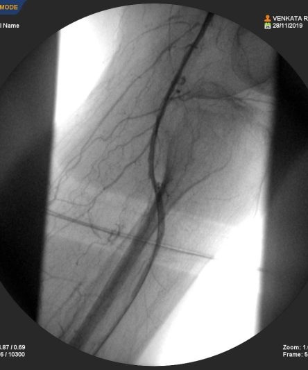 Angioplasty