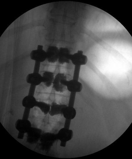 Cement augmented Screw Fixation