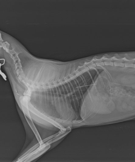 Foreign Body Pin in Esophagus