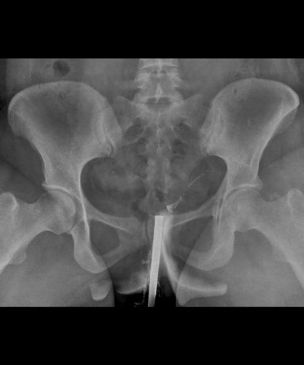 _HSG -Histerosalphingography AP-