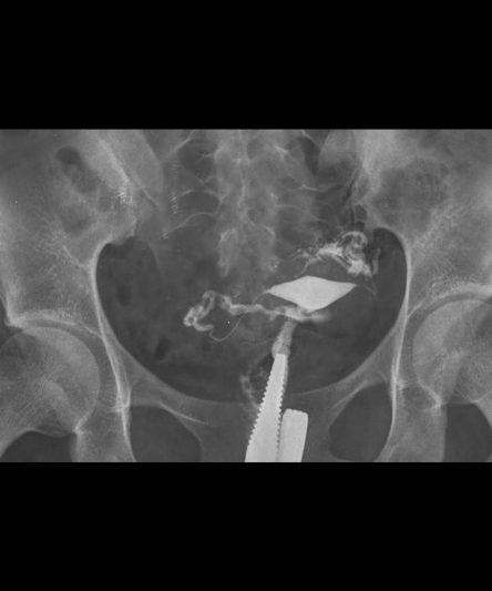 _HSG -Histerosalphingography AP-18