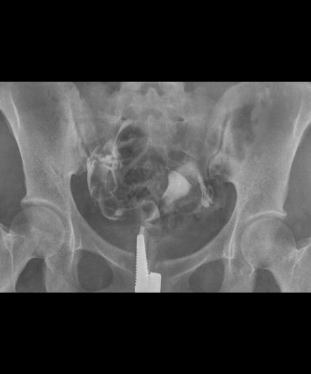 _HSG -Histerosalphingography AP