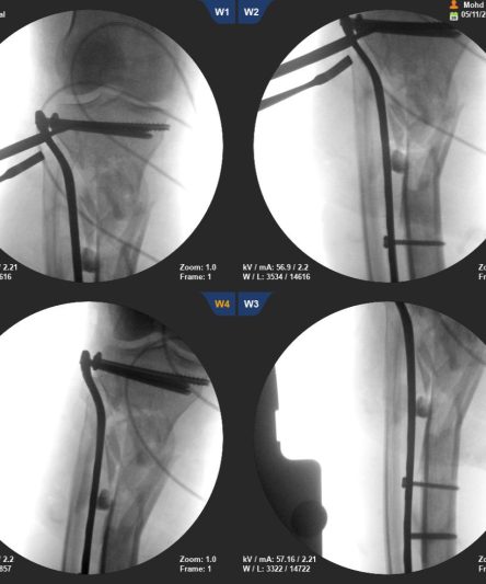 Tibia Plating Multi window 2 PO