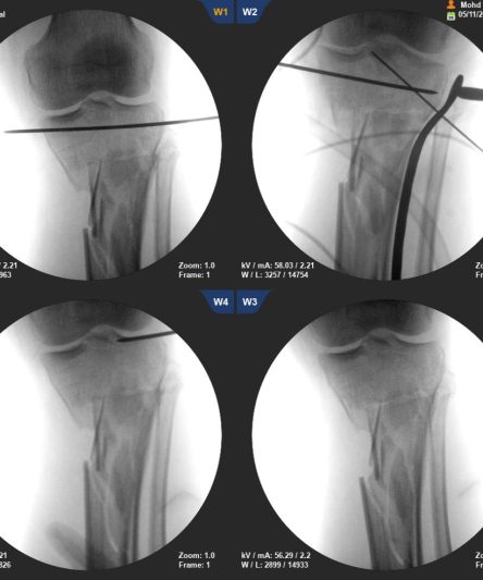 Tibia plating Multi window